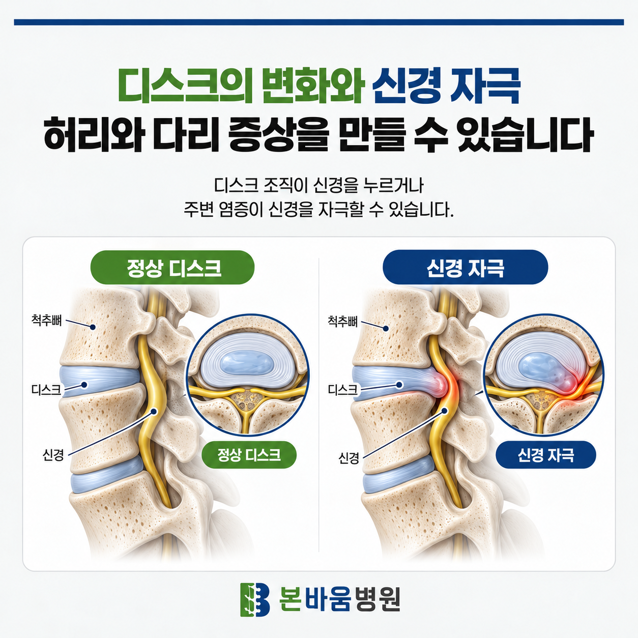 615d57dc6bfc84416f61d25eac82b614_1791942082_7413.png 허리디스크, 다리 저림으로 이어지는 이유