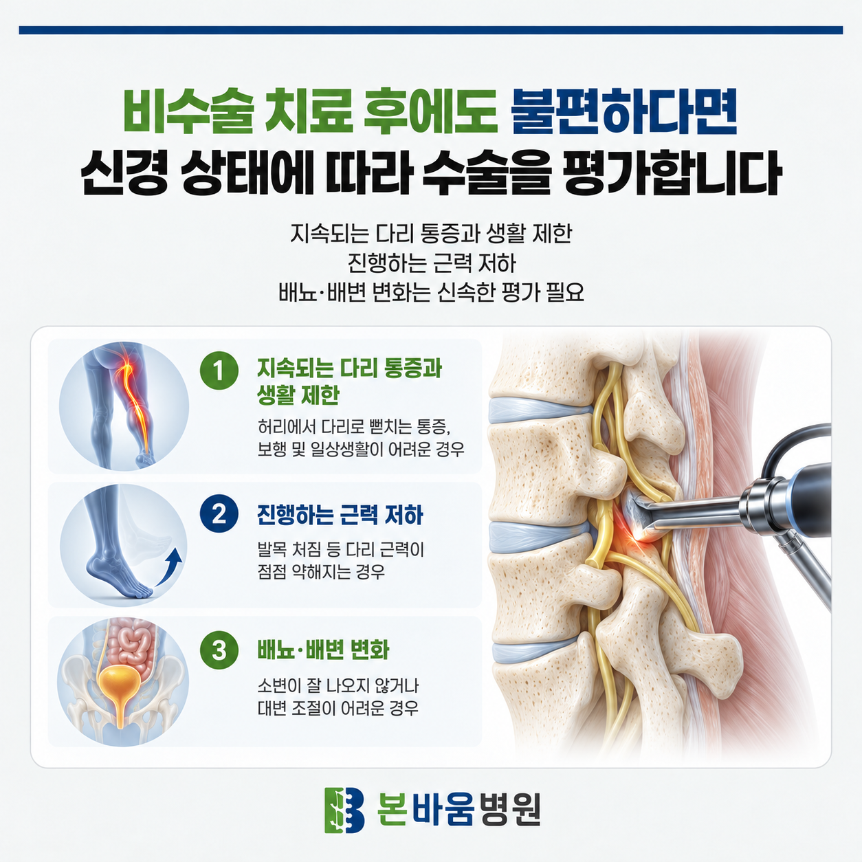 615d57dc6bfc84416f61d25eac82b614_1791942083_5032.png 신경 압박이 지속되면 내시경수술을 검토합니다