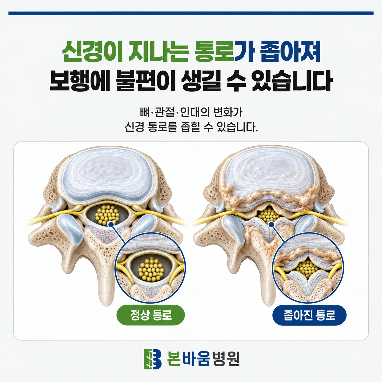 615d57dc6bfc84416f61d25eac82b614_1791942112_4734.png 척추관협착증, 신경이 지나는 공간의 변화
