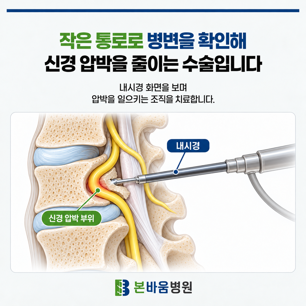 615d57dc6bfc84416f61d25eac82b614_1791942141_3281.png 척추내시경, 신경을 누르는 조직을 치료합니다