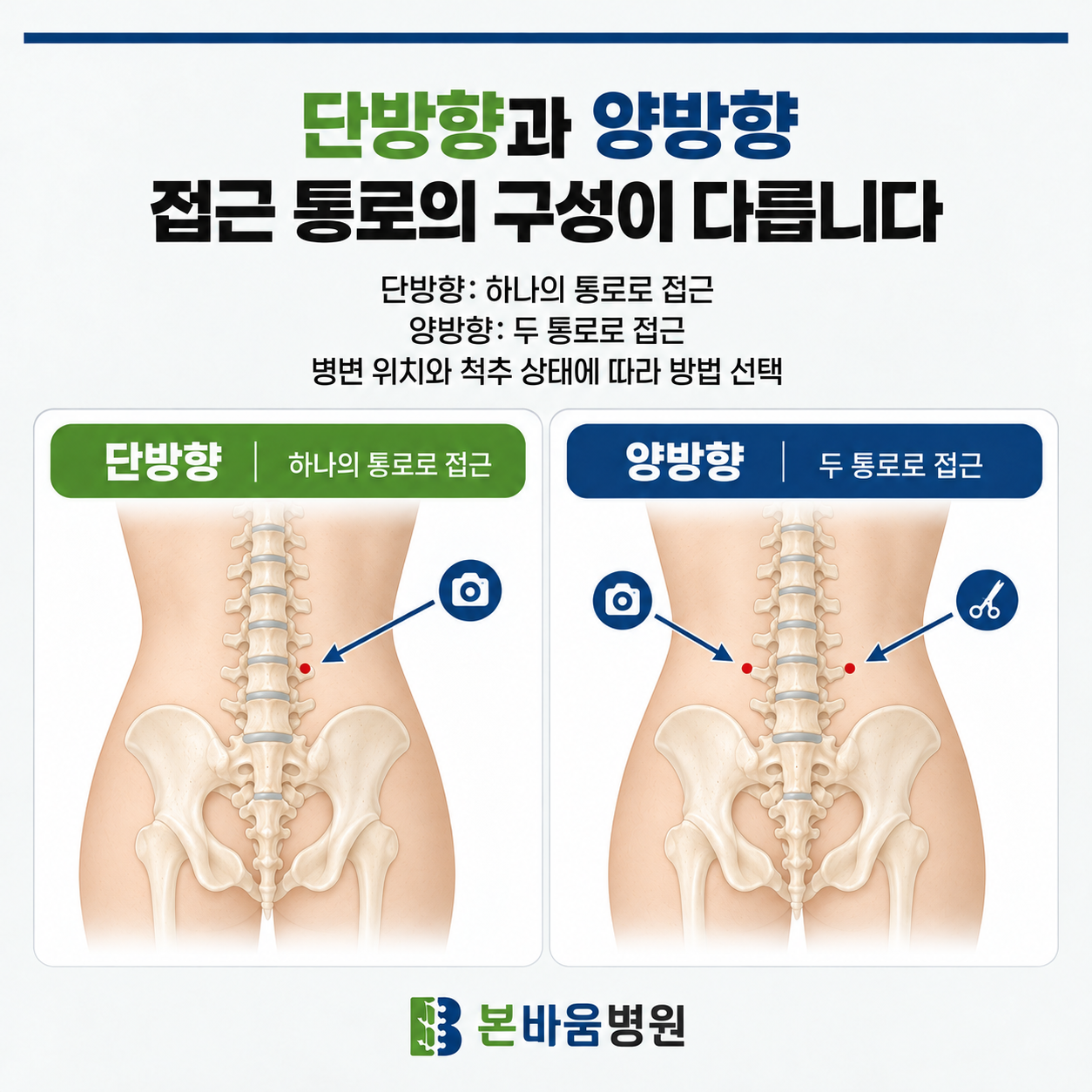 615d57dc6bfc84416f61d25eac82b614_1791942141_8602.png 단방향 척추내시경의 접근과 감압 과정