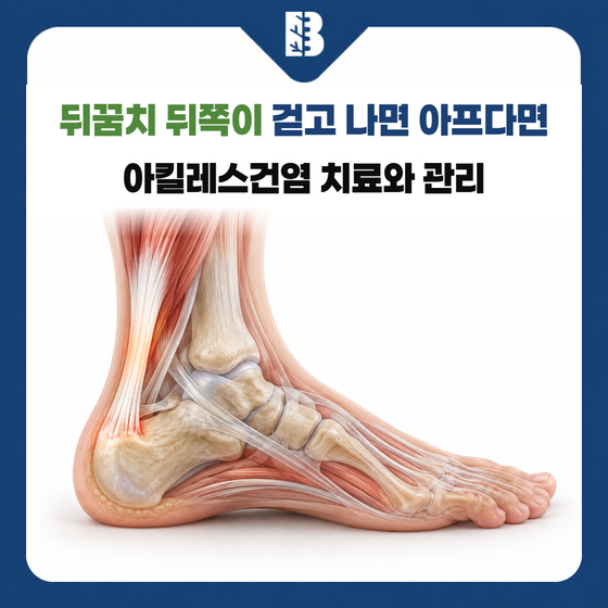 은평구정형외과 아킬레스건과 뒤꿈치뼈의 부착 관계를 보여주는 측면 해부 그림