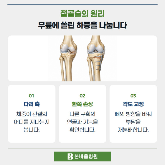 은평구정형외과 무릎 정렬 교정과 고정판 모델 — 절골술의 원리 · 무릎에 쏠린 하중을 나눕니다