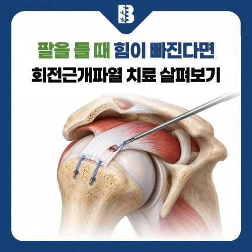 은평구정형외과 회전근개파열, 팔을 들 때 어깨가 아프고 힘이 빠진다면