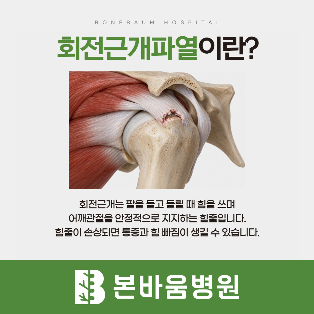 은평구정형외과 회전근개 힘줄이 손상된 위치를 보여주는 어깨 관절 그림