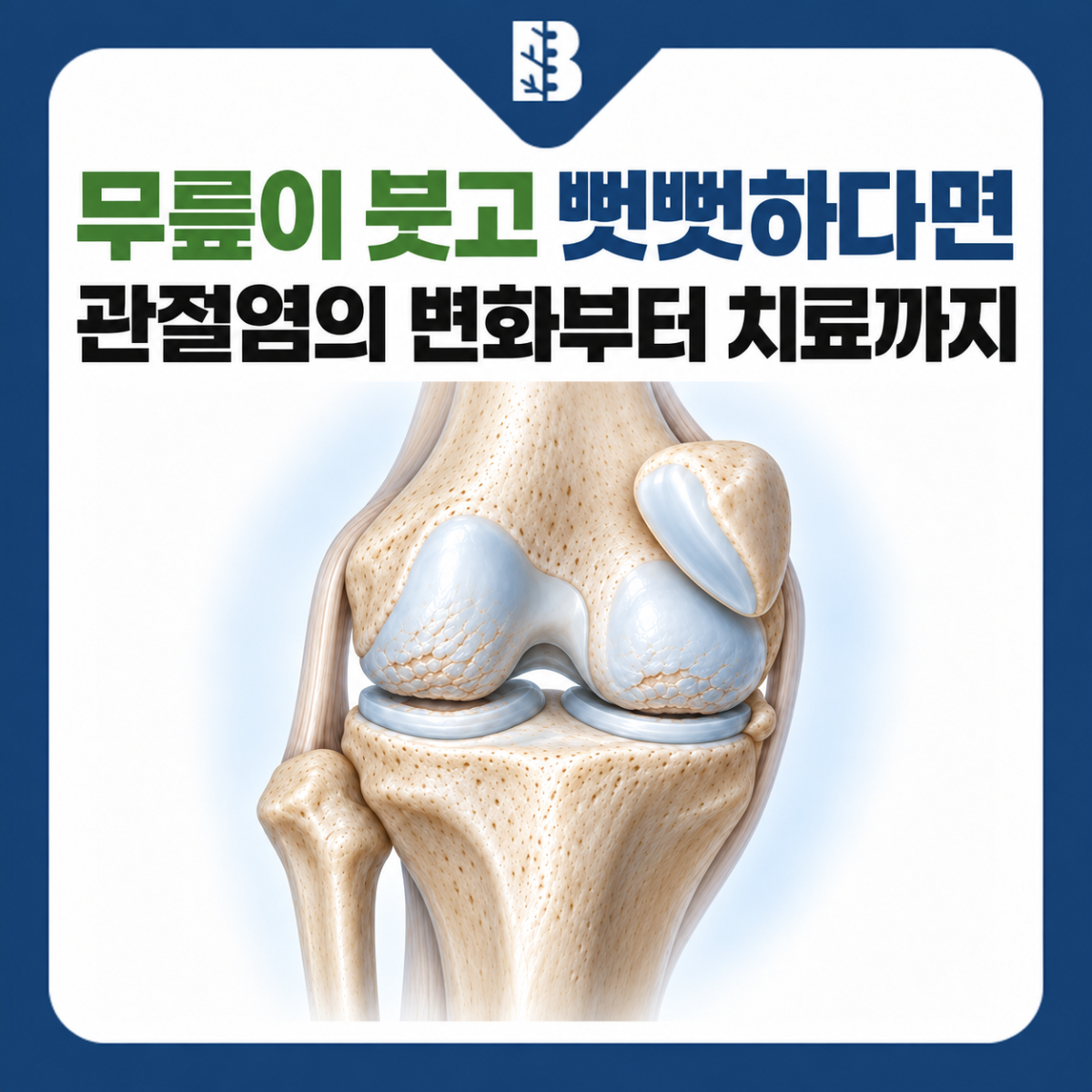 은평구정형외과 무릎관절염과 붓고 뻣뻣한 무릎 증상을 소개하는 관절 구조 그림