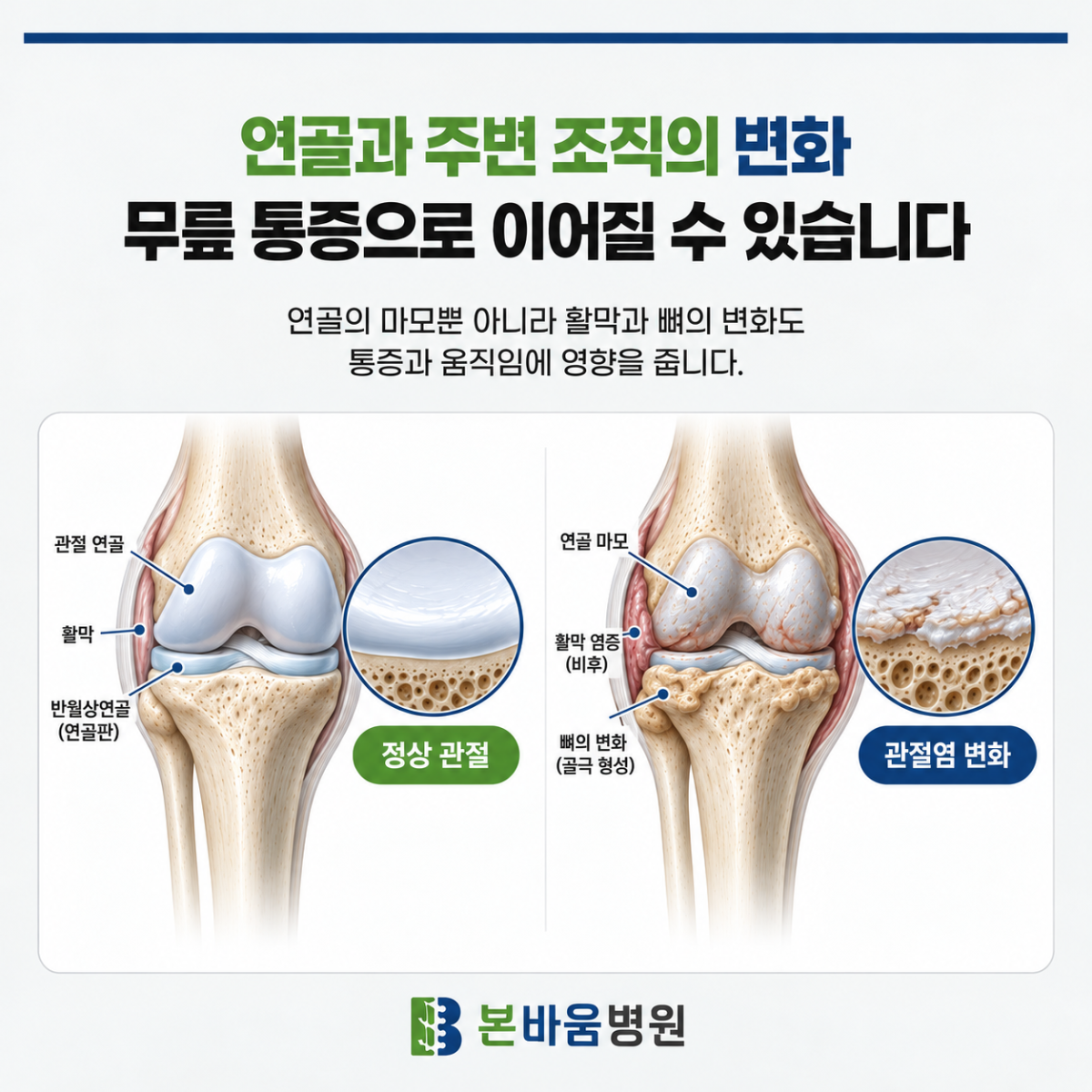 은평구정형외과 정상 무릎과 관절염이 생긴 무릎의 연골·주변 조직을 비교한 그림