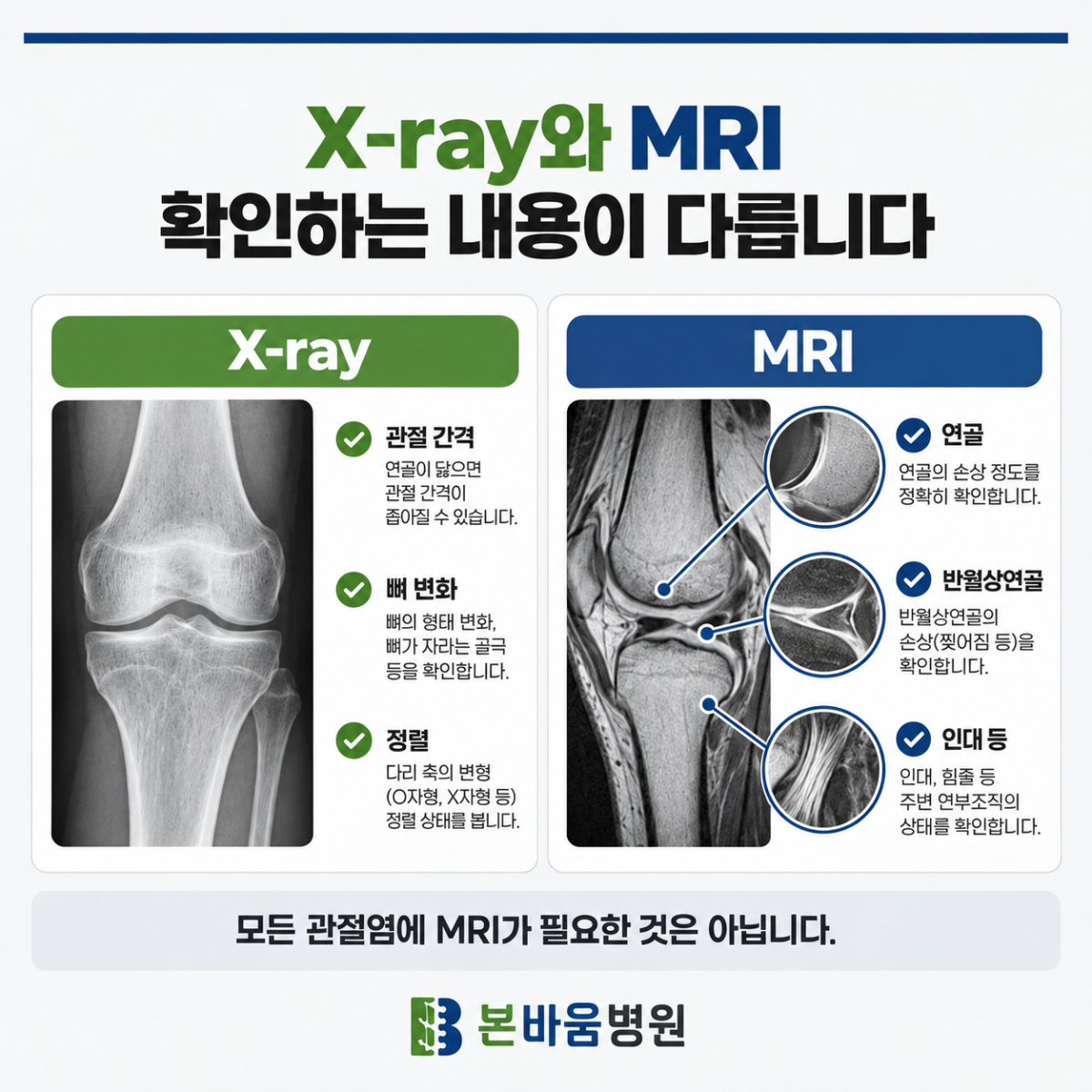 은평구정형외과 무릎 엑스레이와 MRI에서 확인하는 관절 간격·뼈·연골·인대 비교
