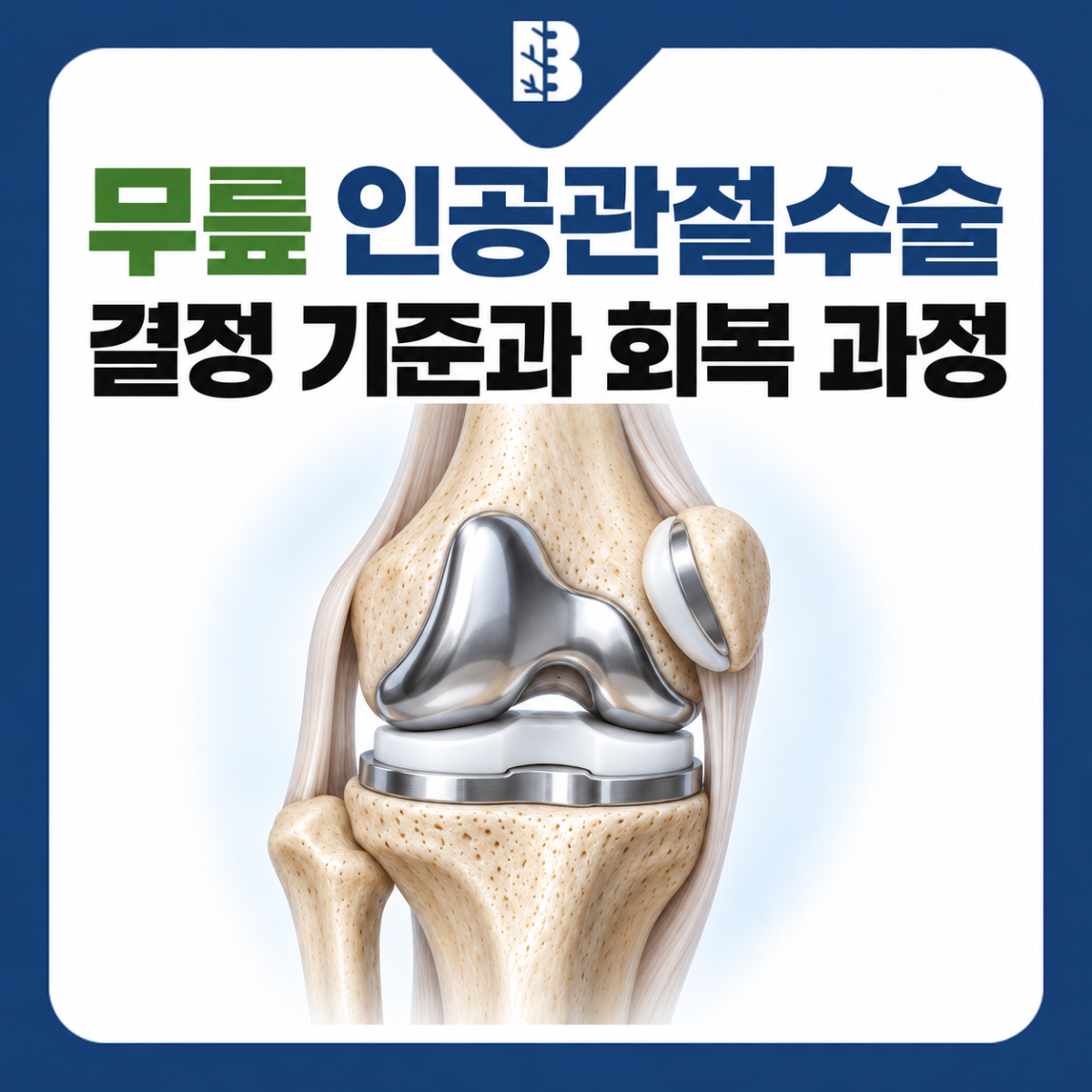 은평구정형외과 무릎 인공관절의 구조와 수술 결정 기준·회복 과정을 소개하는 그림