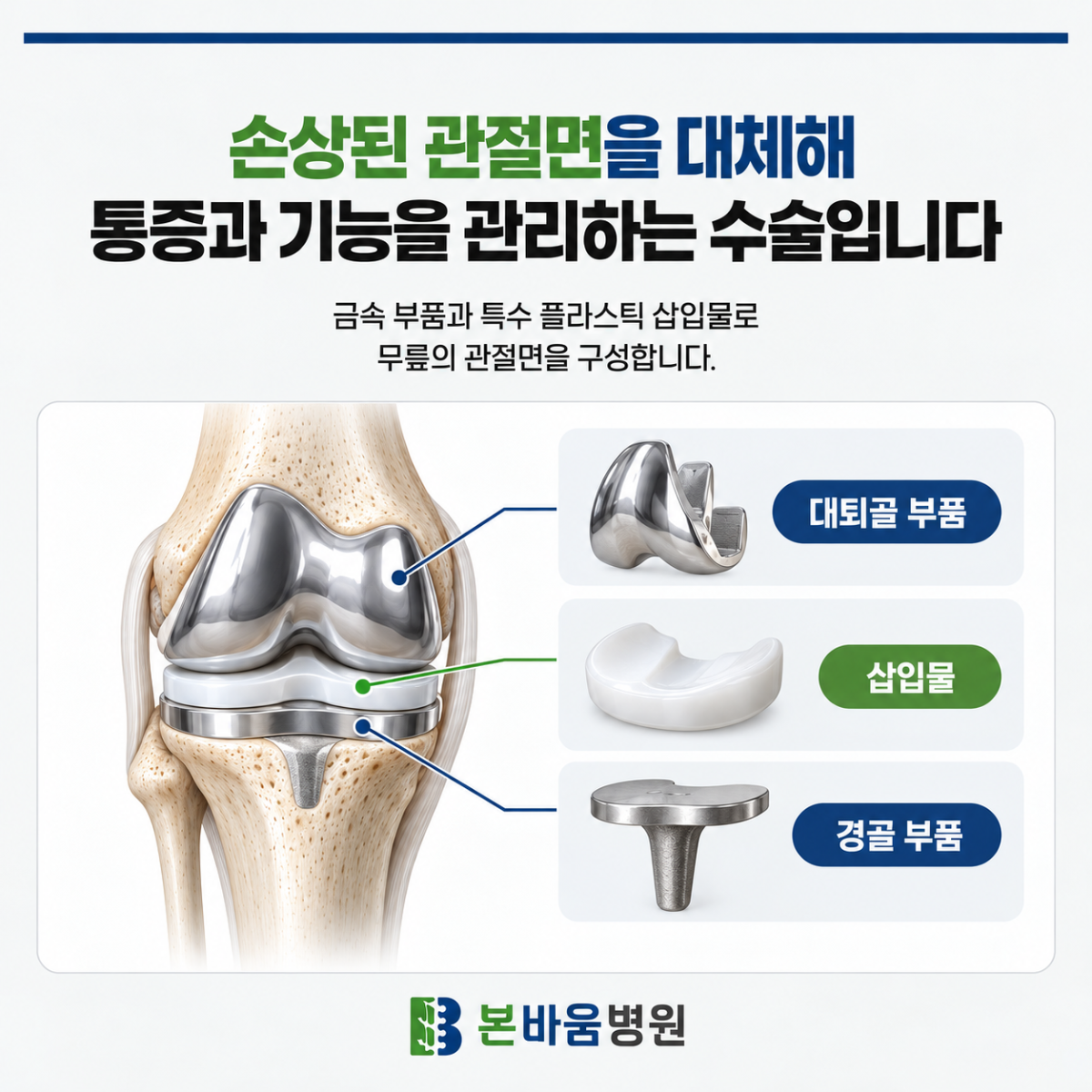 은평구정형외과 무릎 인공관절의 대퇴골 부품·삽입물·경골 부품을 표시한 그림