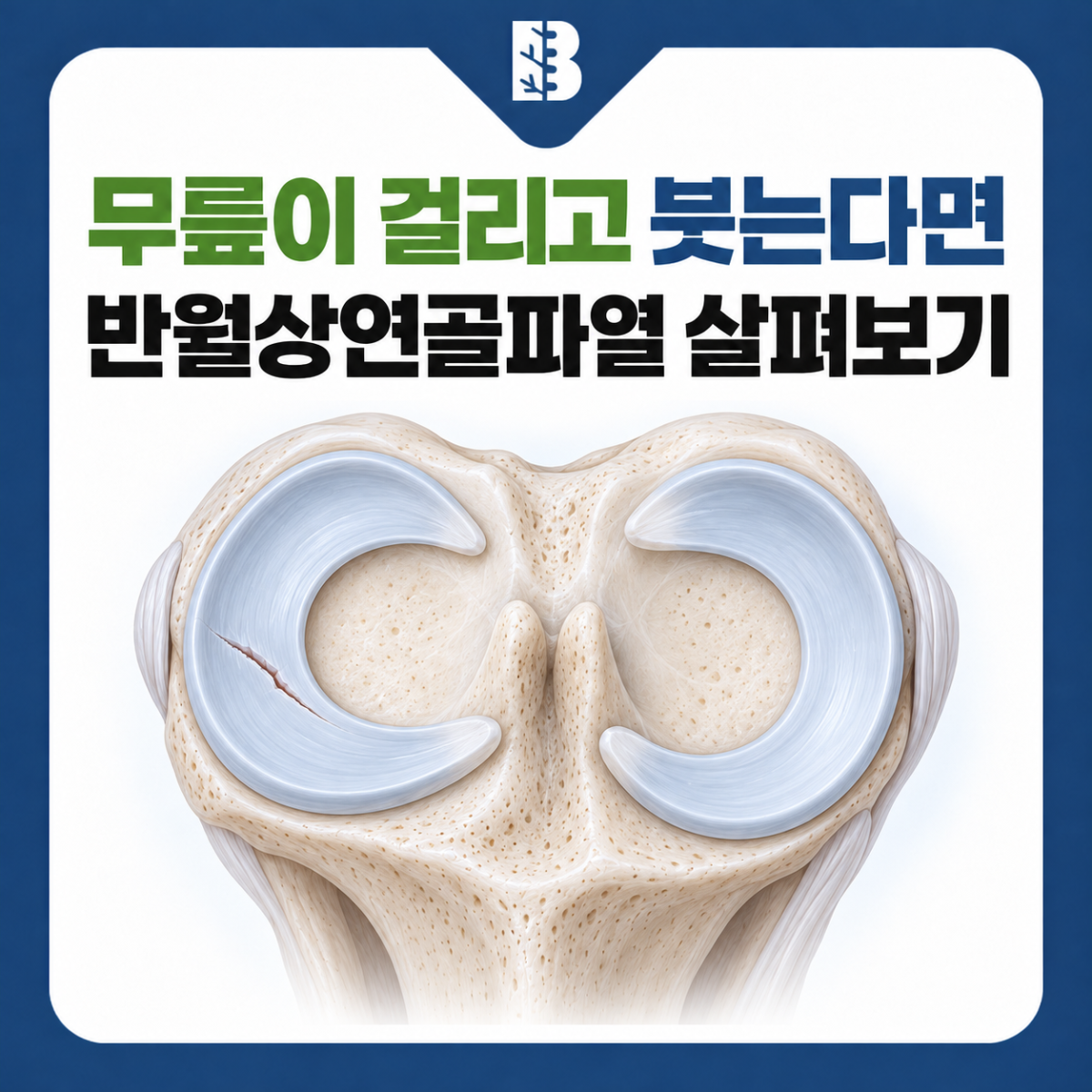 은평구정형외과 무릎이 걸리고 붓는 반월상연골파열을 소개하는 무릎 내부 구조 그림