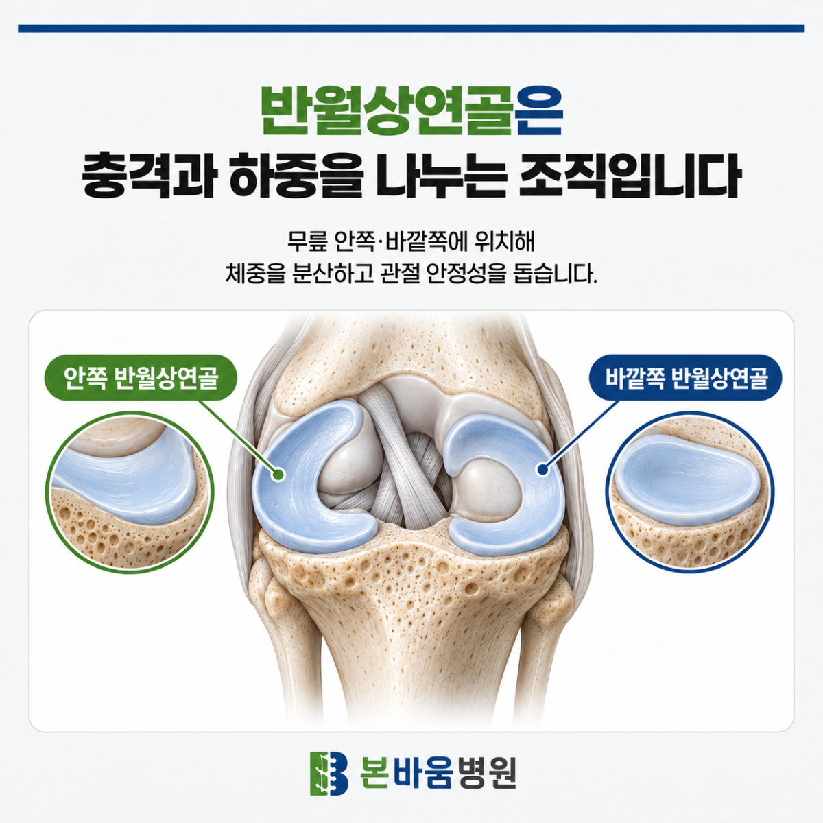 은평구정형외과 무릎 안쪽과 바깥쪽 반월상연골의 위치를 표시한 그림