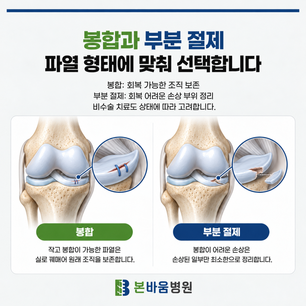 은평구정형외과 반월상연골 봉합과 부분 절제의 차이를 보여주는 수술 그림