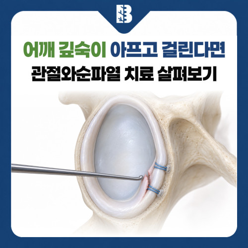 은평구정형외과 관절와순파열, 운동할 때 어깨 깊숙이 아프고 걸린다면