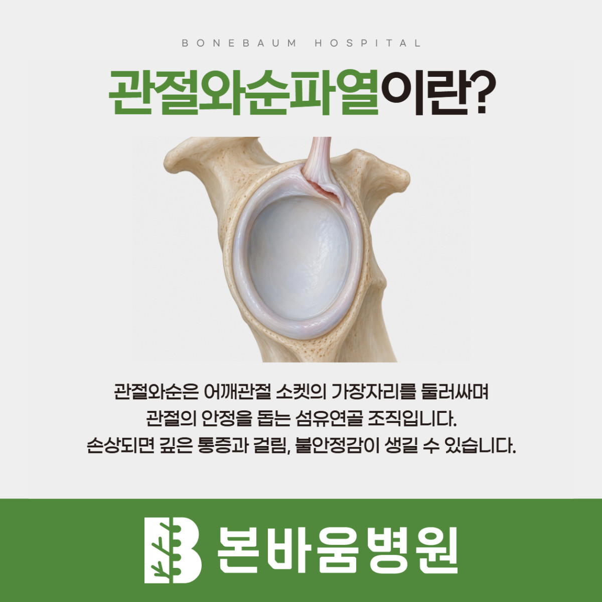 은평구정형외과 어깨 관절 가장자리의 관절와순 위치와 손상을 보여주는 그림