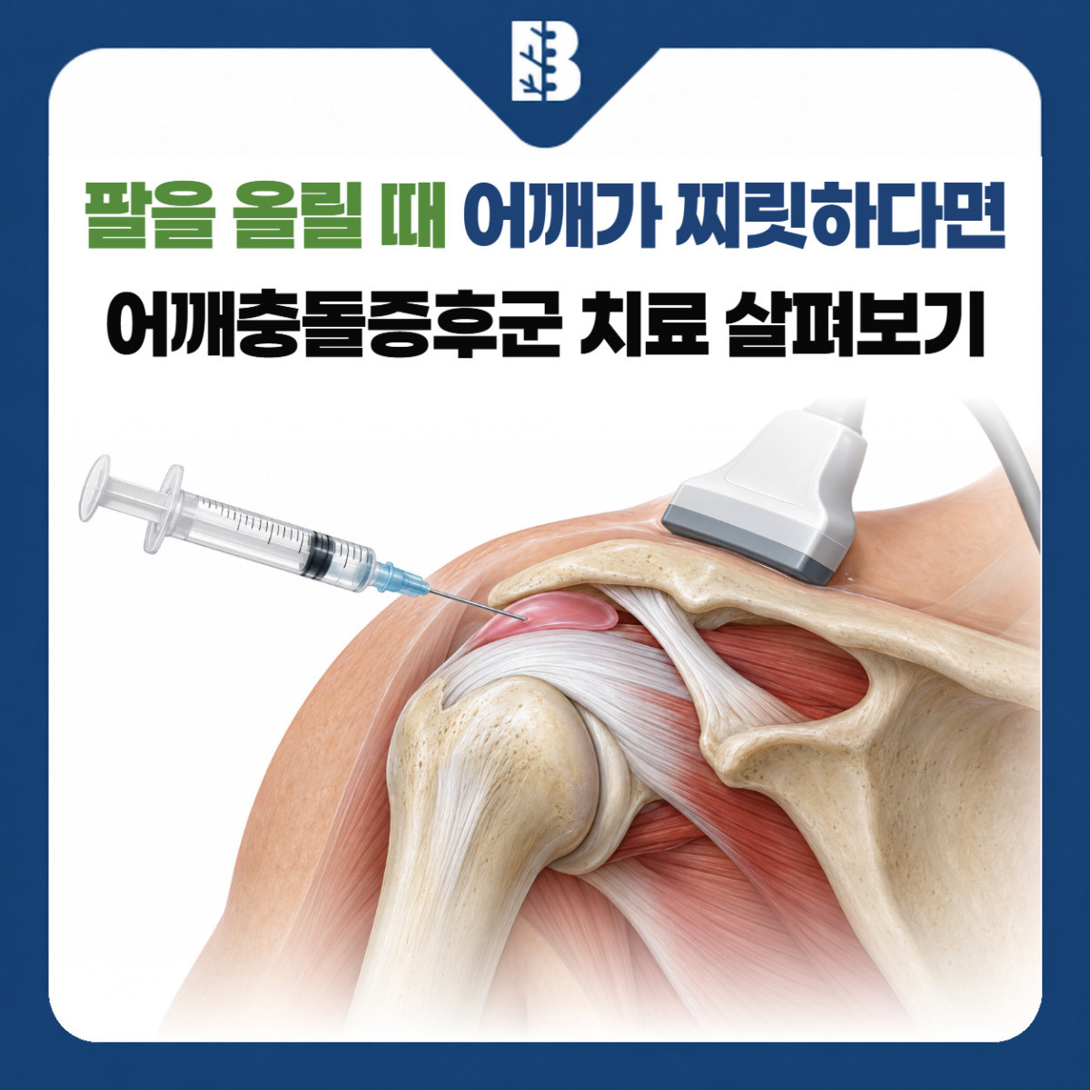 은평구정형외과 어깨충돌증후군 치료를 소개하는 초음파 탐촉자와 주사 위치 그림