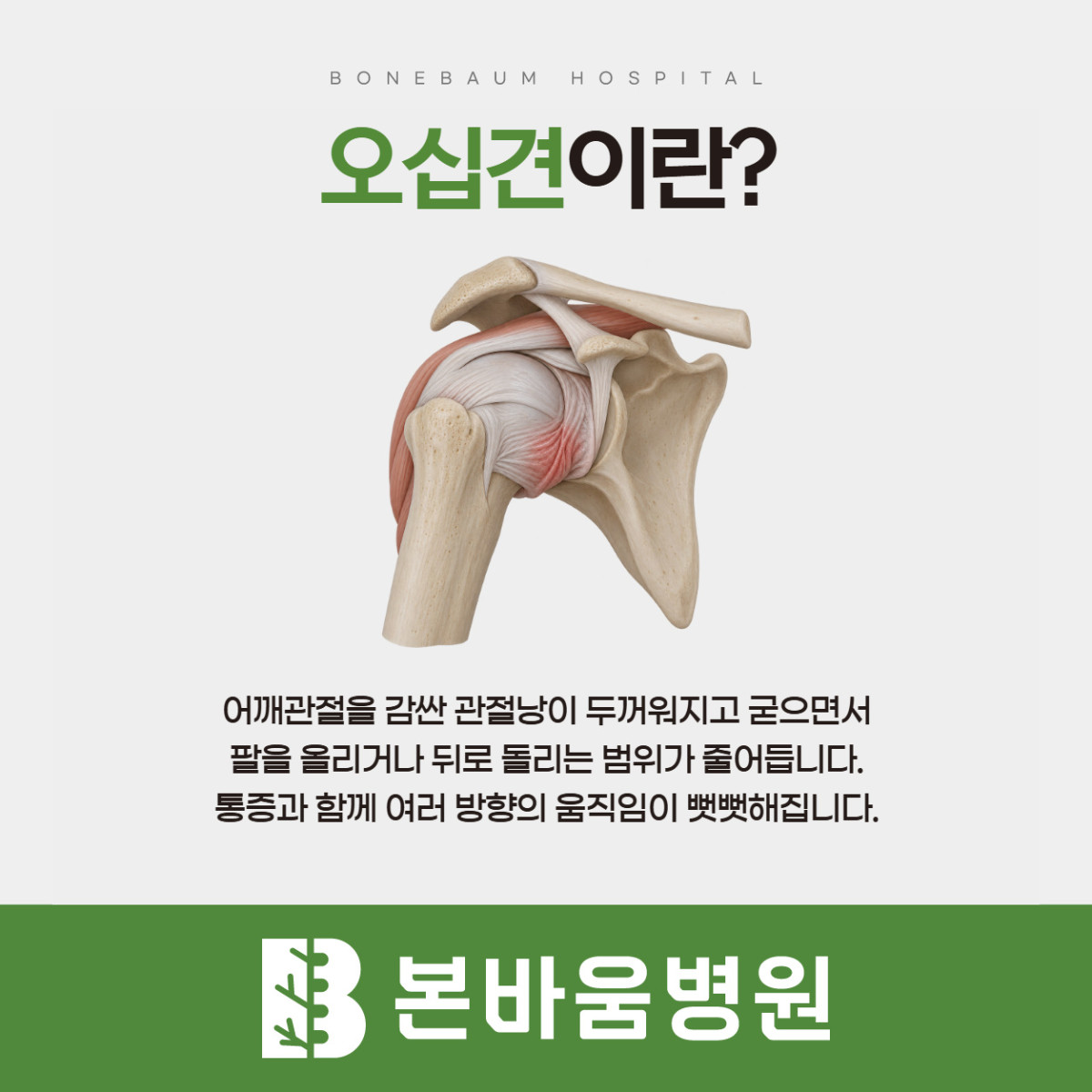 은평구정형외과 오십견에서 두꺼워지고 굳는 어깨 관절낭을 보여주는 그림