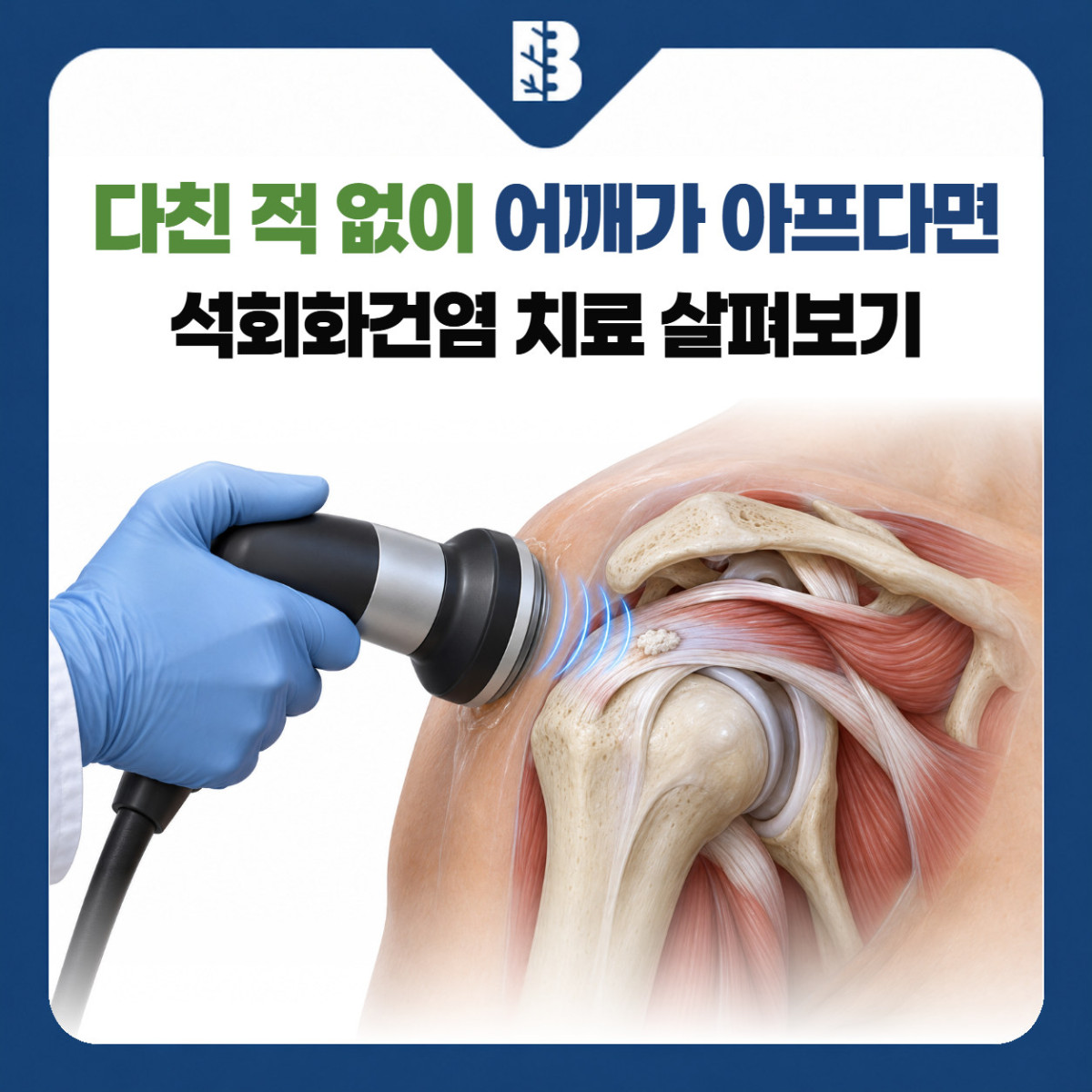 은평구정형외과 석회화건염 치료를 소개하는 어깨 체외충격파와 힘줄 부위 그림