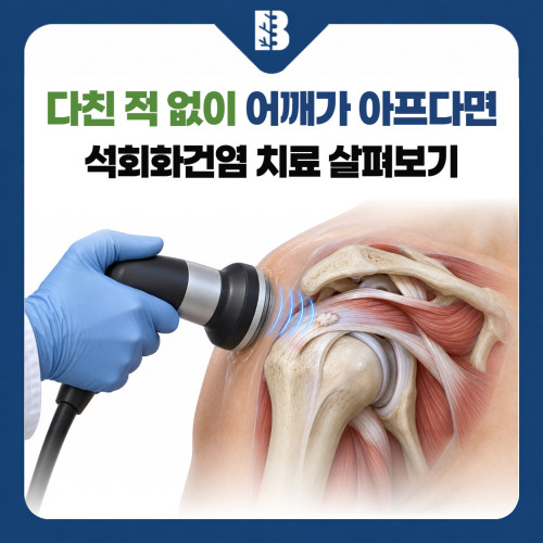 은평구정형외과 석회화건염, 다친 적 없이 갑자기 어깨가 아프다면