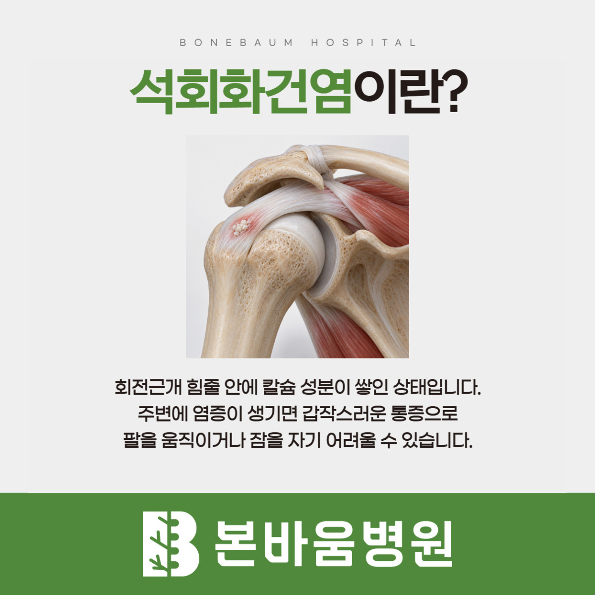 은평구정형외과 회전근개 힘줄에 석회가 쌓인 위치를 보여주는 석회화건염 설명 그림