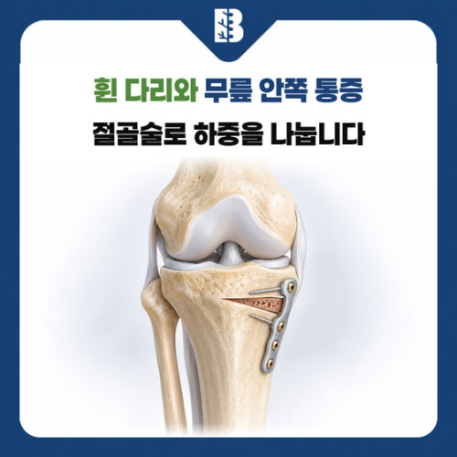 은평구정형외과 휜 다리 절골술, 무릎에 쏠리는 체중을 나누는 수술